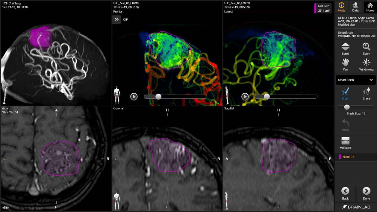 Rys. Precyzyjnie określony (dzięki fuzji badań MR i angiografii) obszar zmiany naczyniowej poddawanej leczeniu radiochirurgicznemu.