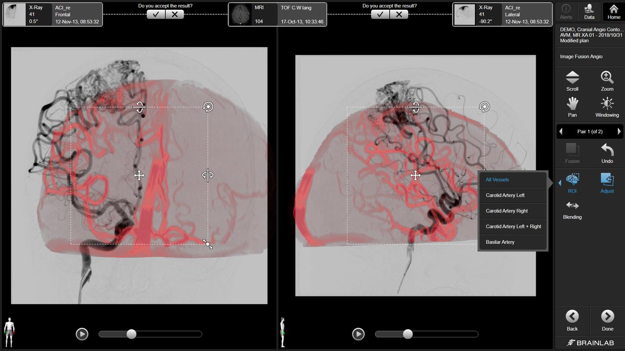 Rys. Korekcja dystorsji obrazów MR. Rys. Przykładowa fuzja badania MR z angiografią, służąca do planowania precyzyjnej radiochirurgii naczyniaka tętniczo-żylnego.